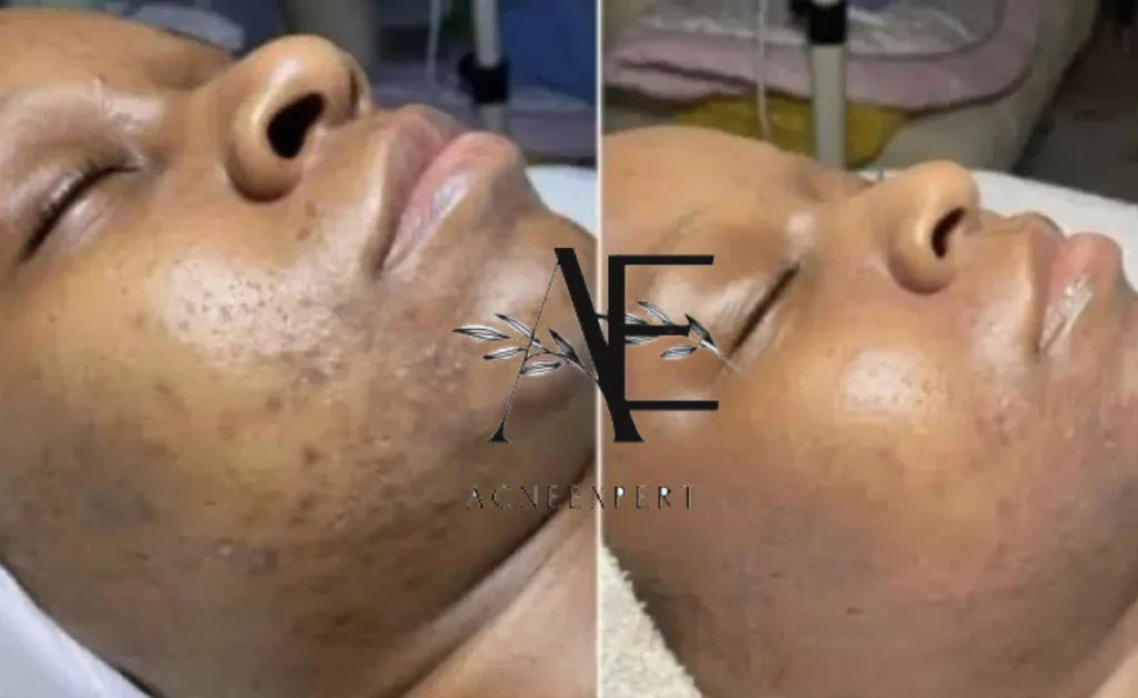 Dark skin woman receiving facial for to remove blackheads