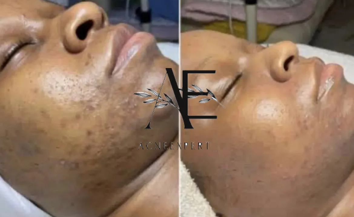 Dark skin woman receiving facial for to remove blackheads